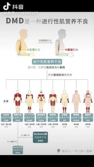Regenxbio杜氏肌营养不良症基因疗法在临床试验中显示肌肉功能改善